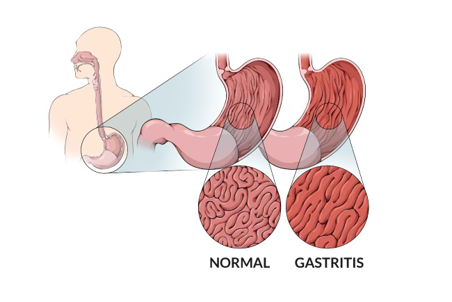Gastritis - Alodokter