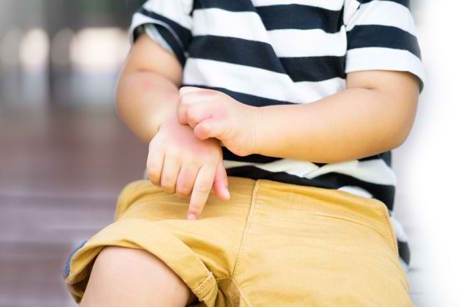Gejala Alergi Dingin Pada Anak Dan Pencegahannya Alodokter
